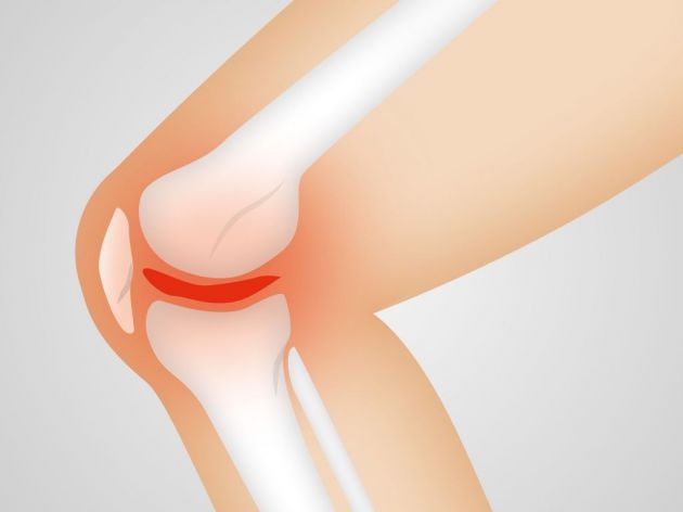 What Is Reactive Arthritis and What Causes It – Surprising Link Between Urinary Infections and Pain in Joints