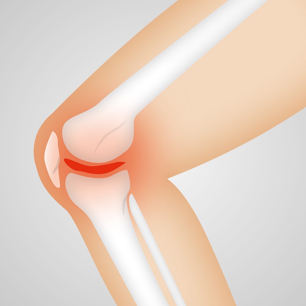 Artritis najčešc&#769;e pogađa koljena ili skočne zglobove